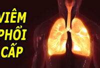 phong-ngua-viem-phoi-cap-mua-nang-nong
