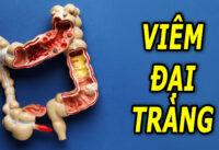 viem-dai-trang-co-nguy-hiem-khong