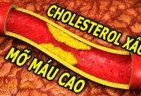 cach-lam-giam-cholesterol-xau-trong-mau