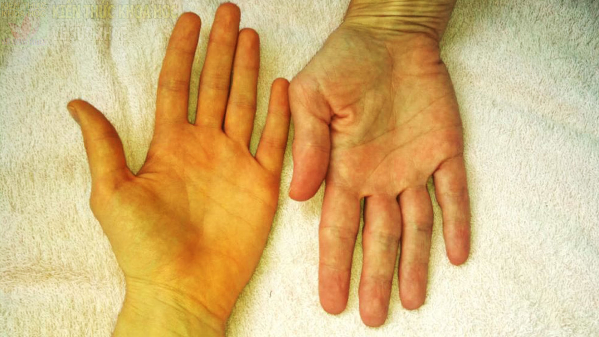 7-trieu-chung-thuong-gap-o-nguoi-bi-viem-gan