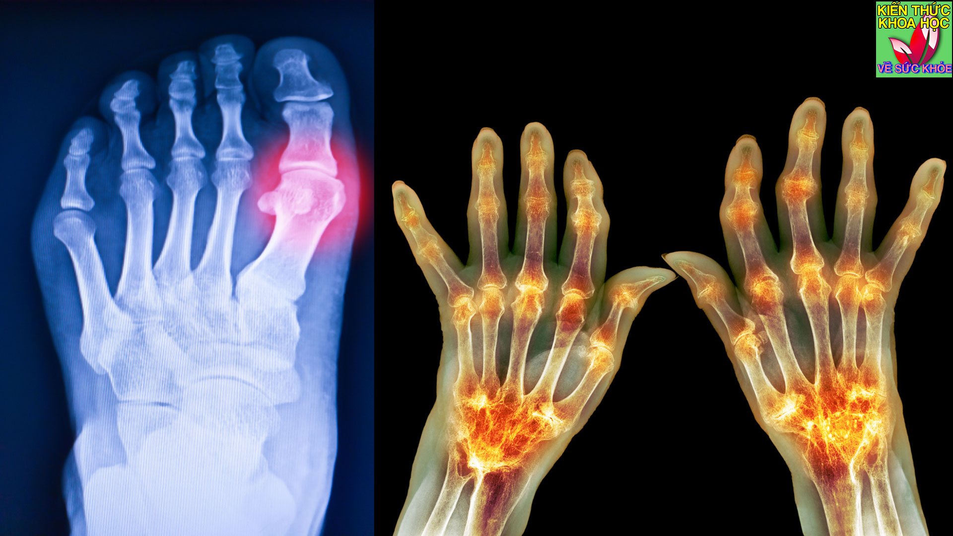 thuc-uong-dac-biet-tot-cho-nguoi-bi-viem-khop-va-benh-gut