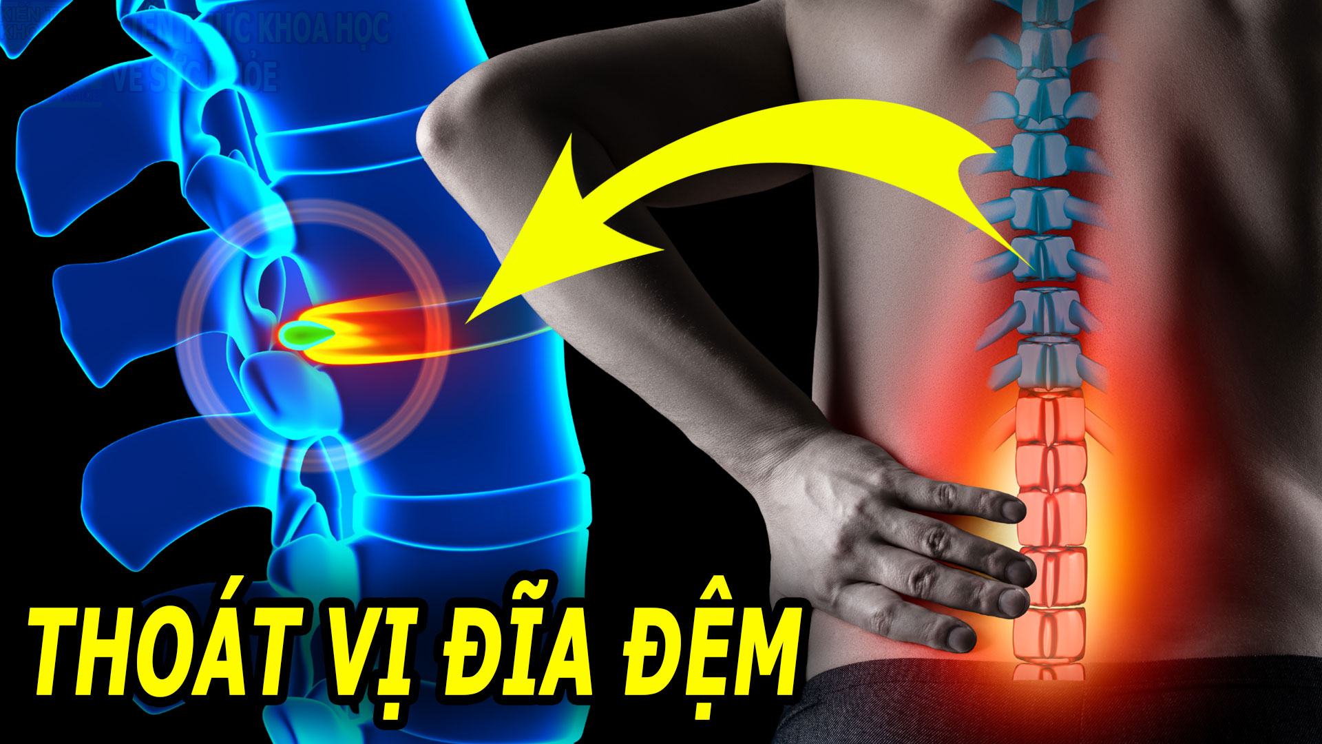 5-nguyen-nhan-gay-thoat-vi-dia-dem-hang-dau-ai-cung-nen-biet-som