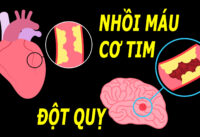 nhoi-mau-co-tim-co-phai-la-dot-quy-khong