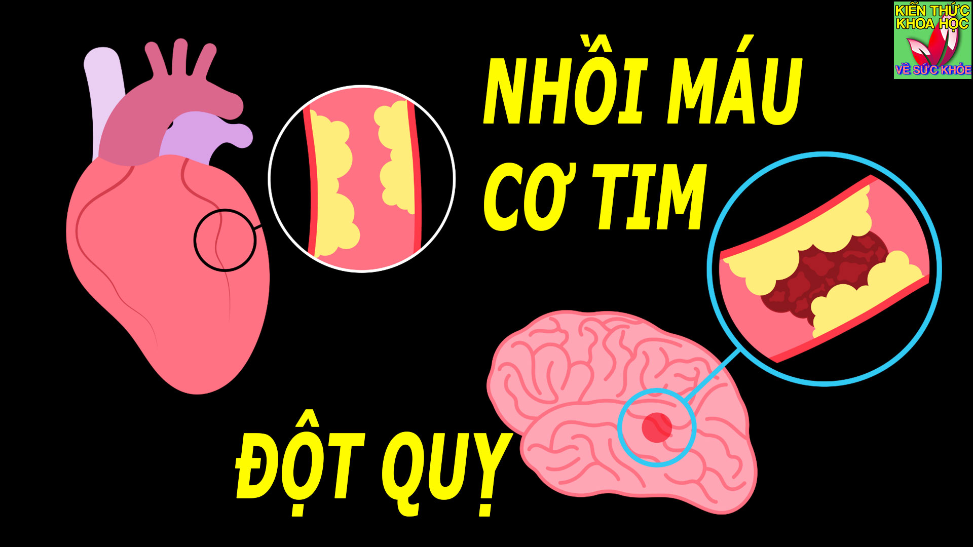nhoi-mau-co-tim-co-phai-la-dot-quy-khong