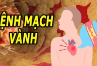 benh-mach-vanh-co-chua-khoi-duoc-khong