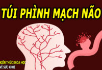 nguy-co-dot-quy-do-tui-phinh-mach-nao