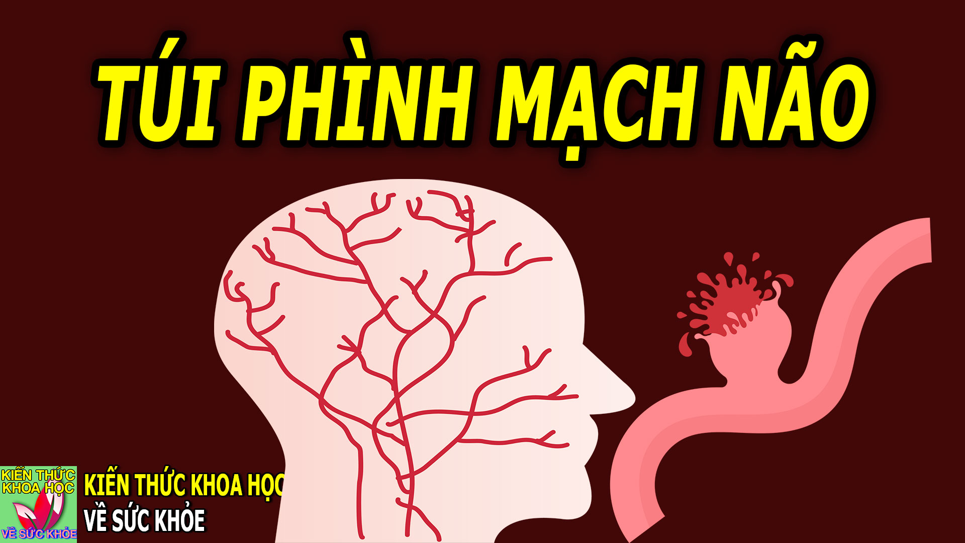 nguy-co-dot-quy-do-tui-phinh-mach-nao