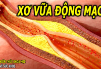 nguyen-nhan-benh-xo-vua-dong-mach