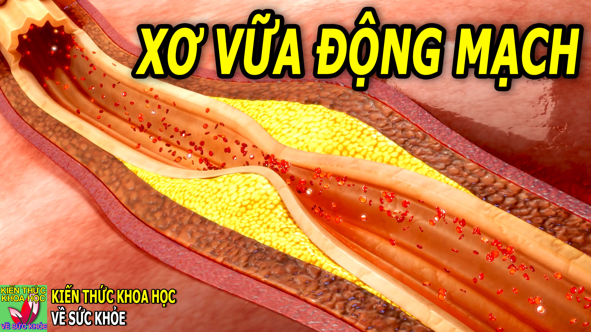 nguyen-nhan-benh-xo-vua-dong-mach